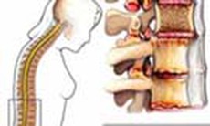 Viêm cột sống dính khớp - Bệnh của nam giới trẻ tuổi